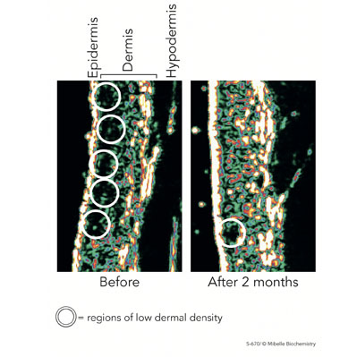 Figure 3: High-resolution ultrasonographic images of epidermis and dermis density before and after 2 months of treatment with PhytoCellTec Md Nu