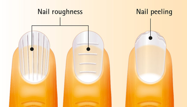 Figure 2: Nail roughness, raggedness and peeling