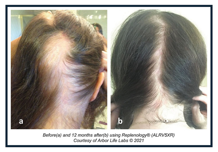 Replenology hair system prevents female hair loss and promotes growth, new study shows