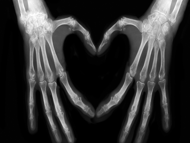 Atlanta researchers show probiotics benefits on fracture healing
