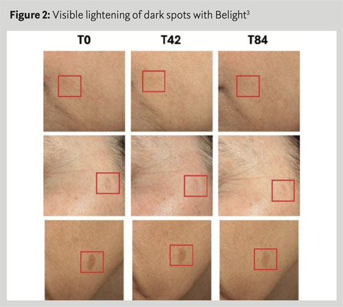 Belight3: the natural ingredient clinically proven to reduce dark spots
