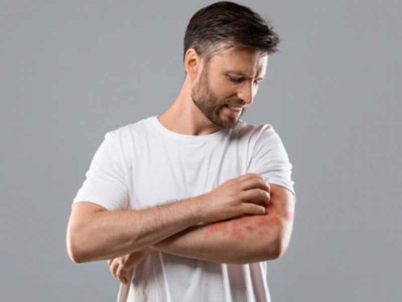 SkinBioTherapeutics receives approval to sell anti-Psoriasis food supplement